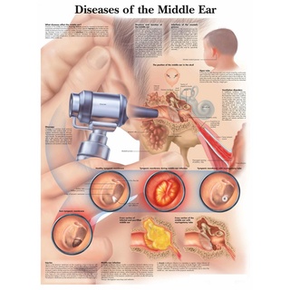 โปสเตอร์ผ้าไหม พิมพ์ลาย Diseases of the Middle Ear สําหรับตกแต่งผนังบ้าน