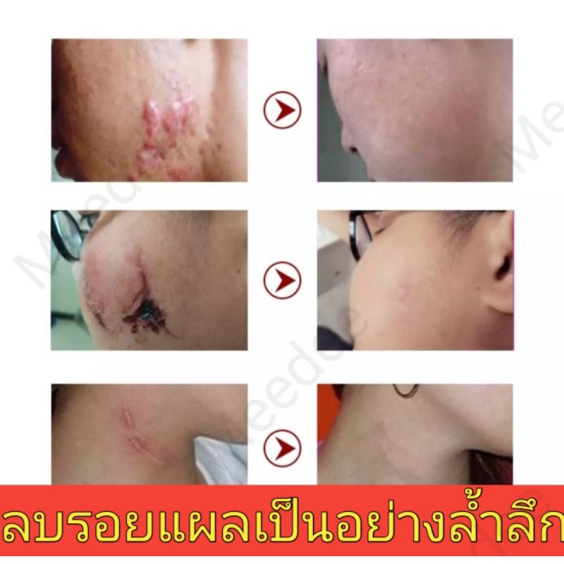 ภาพสินค้าพร้อมส่ง ครีมสมุนไพรจีนลบรอยแผลเป็นอ่อนโยนเห็นผล แท้100% จากร้าน urich.beauty บน Shopee ภาพที่ 1