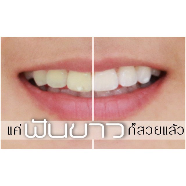 ถูกและดี-ที่ฟอกฟันขาว-20-minute-light-your-smile