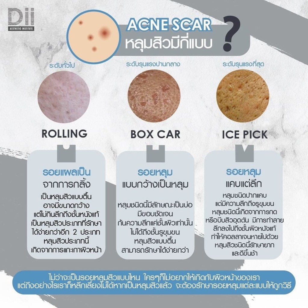 dii-aesthetic-fotona-acne-scar-เลเซอร์รักษาหลุมสิว