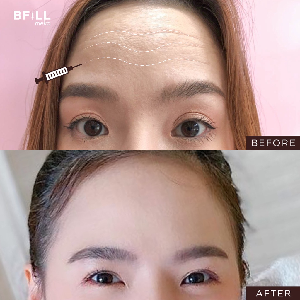 ภาพสินค้าBotox (Aestox) Wrinkles โบท็อก ริ้วรอย จากร้าน mekobfillclinic บน Shopee ภาพที่ 1