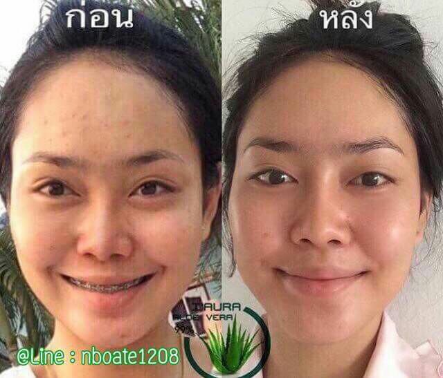 เจลว่านดสิวริ้วรอย