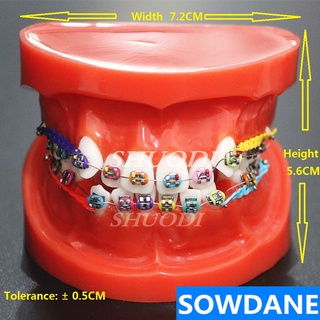 Dental Orthodontic Mallocclusion Model Decoration with Brackets Archwire buccal tube Tooth Extraction for Patient Commun