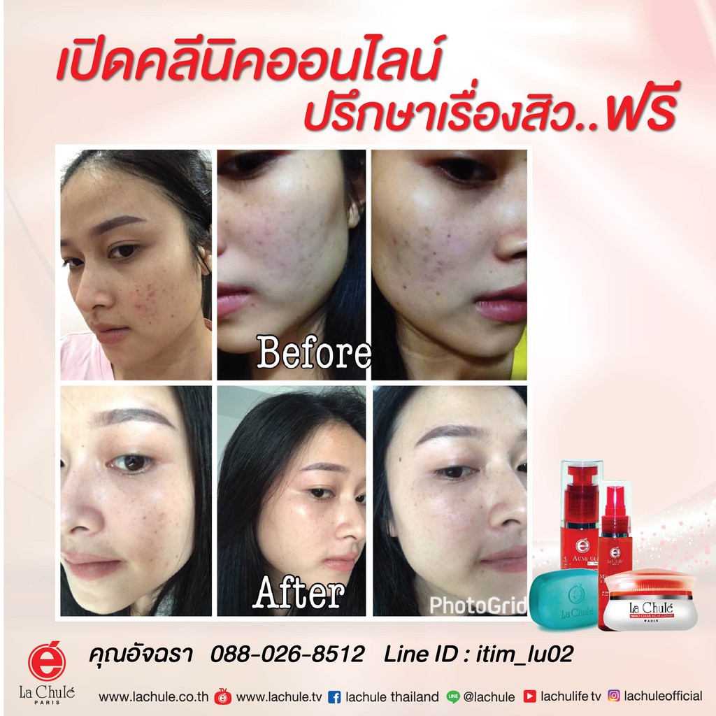 ครีมรักษาสิวลาชูเล่-ครีมฝาแดง-รักษาสิว-ลดอาการอักเสบ-รอยสิว-lachule-clear-acne-cream