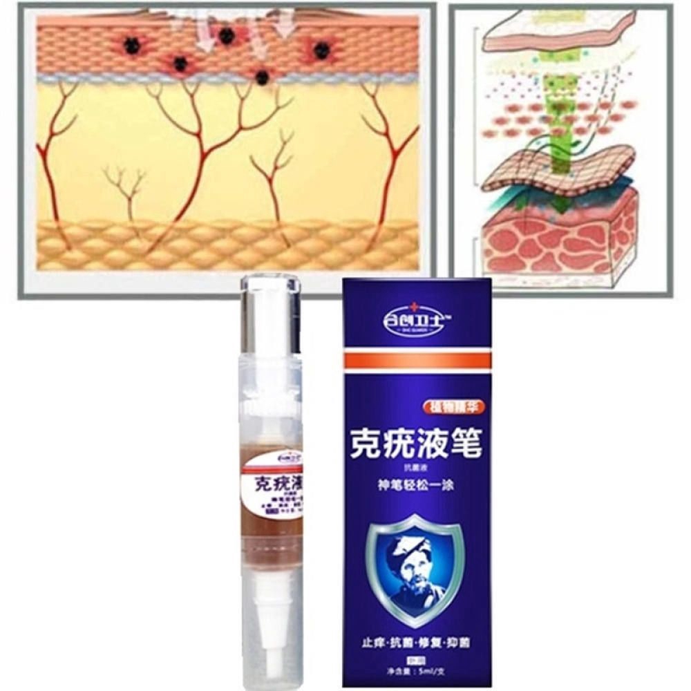 body-warts-treatment-cream-skin-tag-remover-foot-corn-removal-plantar-genital-warts-ointment-footครีมกำจัดหูดที่ผิวหนัง