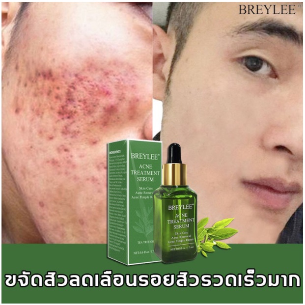 ของแท้-breylee-เซรั่มลดสิว-ครีมลดสิว-ครีมแต้มสิว-เจลแต้มสิว-เจลรักษาสิว-ครีมกำจัดสิว-ครีมรักษาสิว-ครีมสลายสิว-กำจัดสีว