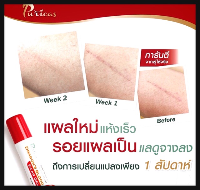 puricas-dragon-blood-scar-gel-8g-เจลลดรอยแผลเป็น-รอยสิว-รอยแดง-รอยดำ-ช่วยฟื้นฟูผิว-อ่อนโยนต่อผิวแพ้ง่าย-รอยแผลดูจางลง