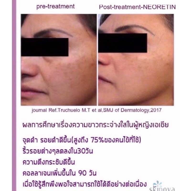 ส่งฟรี-neoretin-serum-30ml-gel-cream-spf50-40ml-ลดฝ้า-กระ-จุดด่างดำ-ผิวหมองคล้ำ-สีผิวไม่สม่ำเสมอ