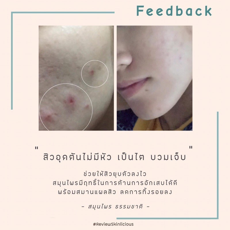 เซรั่มแต้มสิว-สูตรเย็น-สิวยุบไวทันใจ-skinlicious