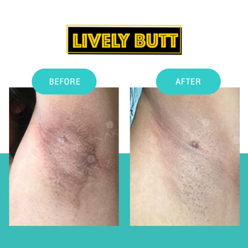 nakiz-lively-butt-100-ml-แก้ปัญหา-ก้นดำ-รักแร้ดำ-ขาหนีบดำ-ลบเลือนรอยดำ-มีสินค้าในไทย