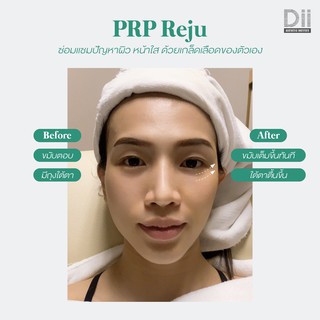 ภาพขนาดย่อของภาพหน้าปกสินค้าDii Aesthetic : PRP Reju 1 Time (2หลอด) กระตุ้นคอลลาเจน ผิวใส จากร้าน dii_aesthetic บน Shopee