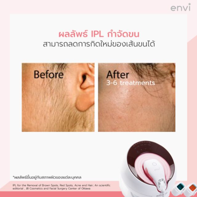 envi-hair-removal-ใช้สำหรับรุ่น-pl3000-ตลับทรีทเม้นท์กำจัดขนถาวร