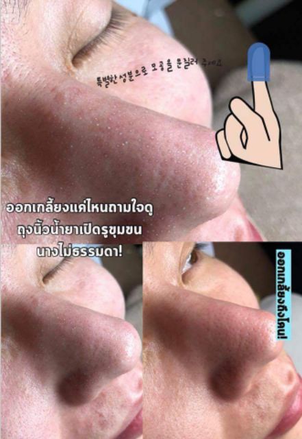 ถุงนิ้วสครับ-ขจัดสิวเสี้ยน-สิวอุดตัน