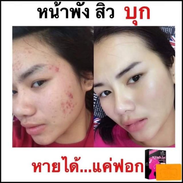 สบู่กูลต้า-ไวท์-รักษาสิว-ฝ้า-100-ก้อน