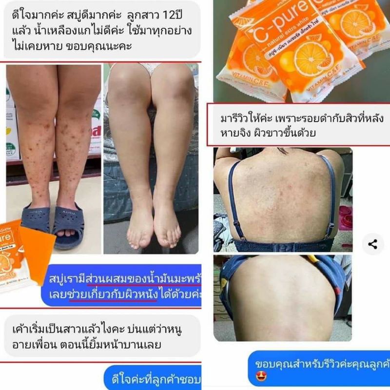 สบู่ซีเพียว-สบู่แก้ขาลาย-ท้องลาย-ผิวดําคลํ้า