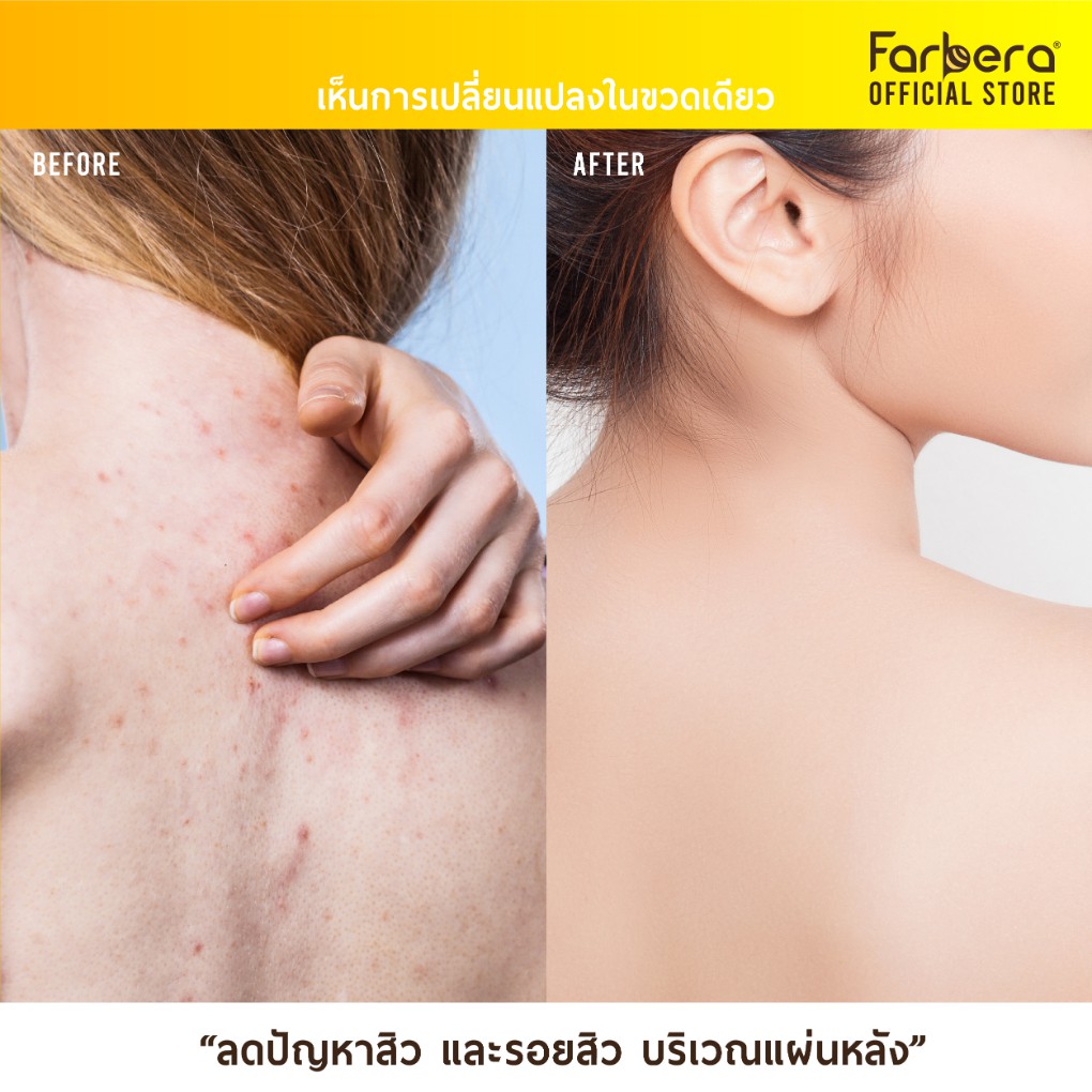 ส่งฟรี-farbera-ingrow-care-60มิล-12-กล่อง-รักษาขนคุด-ทาขนคุด-สิวที่หลัง