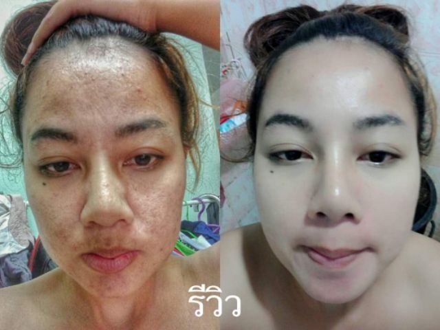 ส่งฟรี-ถูกที่สุด-โปรเซตคู่-2-แถม-1-สุดคุ้ม-โบทาย่า-มาร์กดูดสิว-เห็นผลจริง