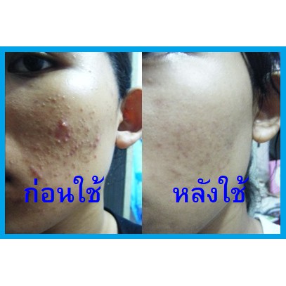 aha-bha-acness-clear-gel-500-g-aha-15-bha-2-รอยสิว-สิวอุดตัน-สิวผด-เร่งผิวขาว-ผลัดเซลล์ผิว-รอยดำ-รูขุมขน-กระชับ