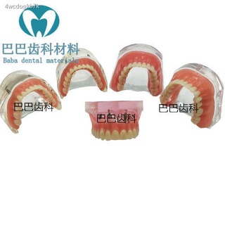 ทันตกรรมโมเดลการบูรณะรากฟันเทียม ฝาปิดบอลแบบเกลียวเทียมร่วมกับฟันปลอมแบบฟันเทียม รุ่นการบูรณะฟัน