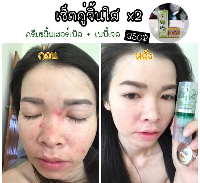 บอกลาหน้าสิว-herbal-ครีมขมิ้นแท้100-มี-อย-ไร้สาร