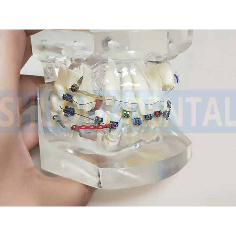 transparent-dental-orthodontic-mallocclusion-model-with-mental-ceramic-brackets-archwire-buccal-tube-for-patient-communi