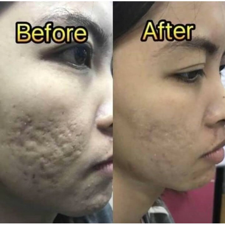 ภายใน-3-นาที-ครีมลบหลุมสิว-รอยเหี่ยวย่น-ถุงใต้ตาageless-จำนวน-1-แผง-5-หลอด