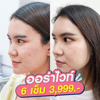 ราคาE-voucher ออร่าไวท์ ลดรอย/ฉีดหน้าใส ปรับสมดุลผิว คละสูตรได้ 6 เข็ม MEGA CLINIC เมกะคลินิก