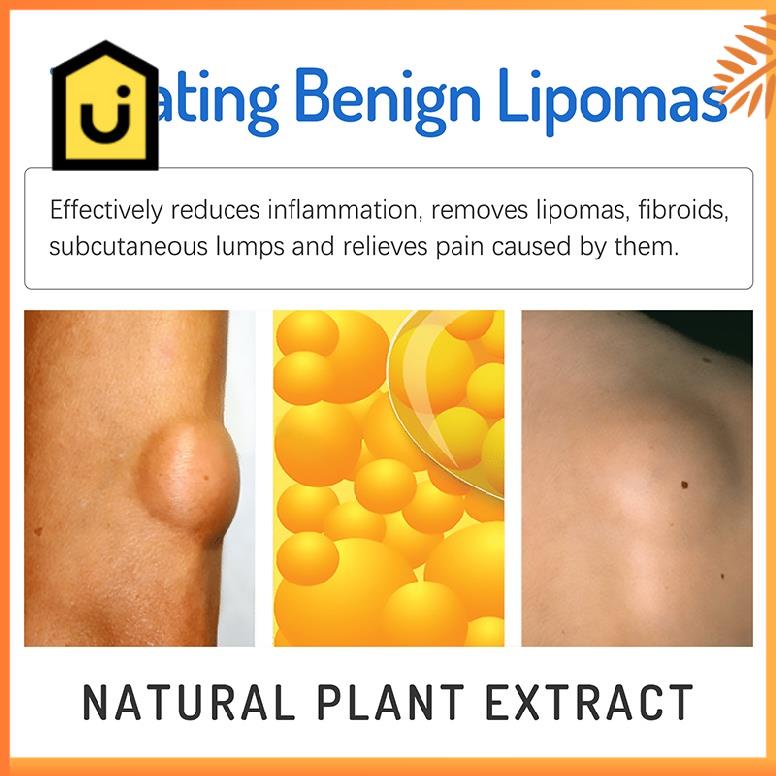 bioaoua-lipoma-removal-cream-ครีมสลายไขมันครีมไขมันครีมลดการก่อตัวไขมันครีมกำจัดไขมันก้อนครีมสลายไขมันก้อนครีมลดไขมั