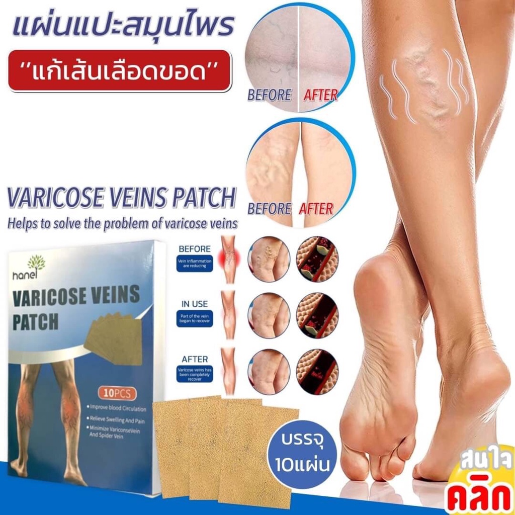 เส้นเลือดขอด-varicose-veins-patch-แผ่นแปะ-สมุนไพร-แผ่นแปะสมุนไพรแก้เส้นเลือดขอด-10-แผ่น