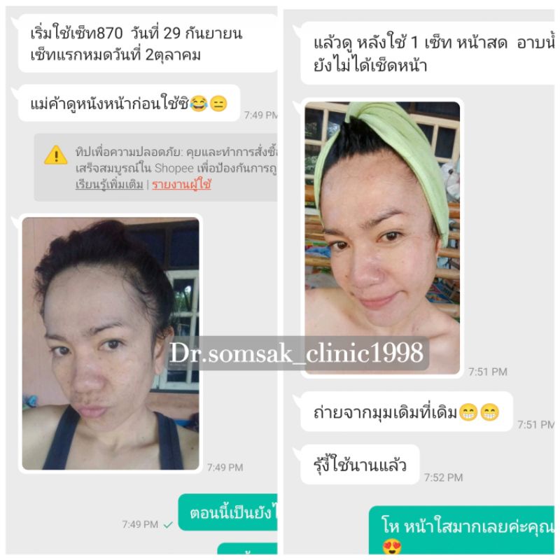 ส่งฟรี-ครีมทาฝ้า-ครีมฝ้าเย็น-รักษาฝ้า-ทาก่อนนอน-คลินิกหมอสมศักดิ์