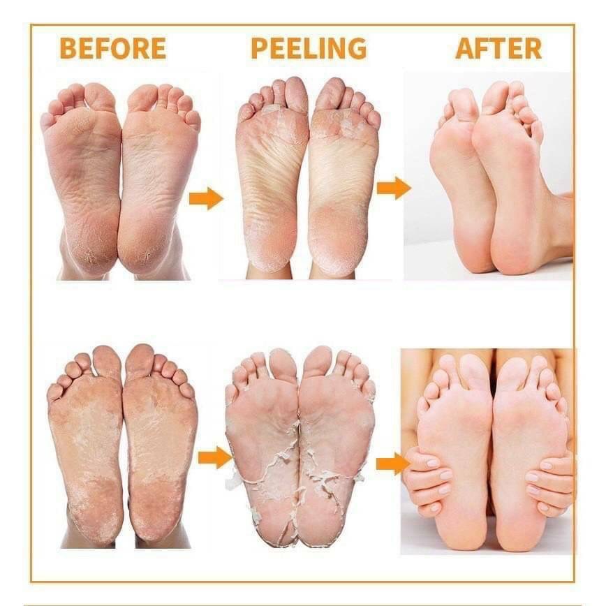 มาส์กเท้า-มาส์กลอกเท้า-foot-peel-mask-ถุงลอกเท้า-แก้ปัญหาส้นเท้าแตก-คละกลิ่น-สินค้าพร้อมส่ง