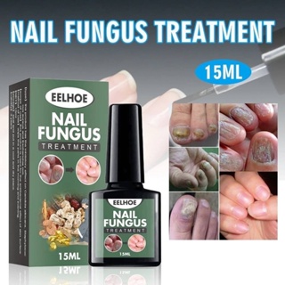 Eelhoe nail fungus น้ำยาบำรุงเล็บกำจัดเชื้อราที่เล็บ