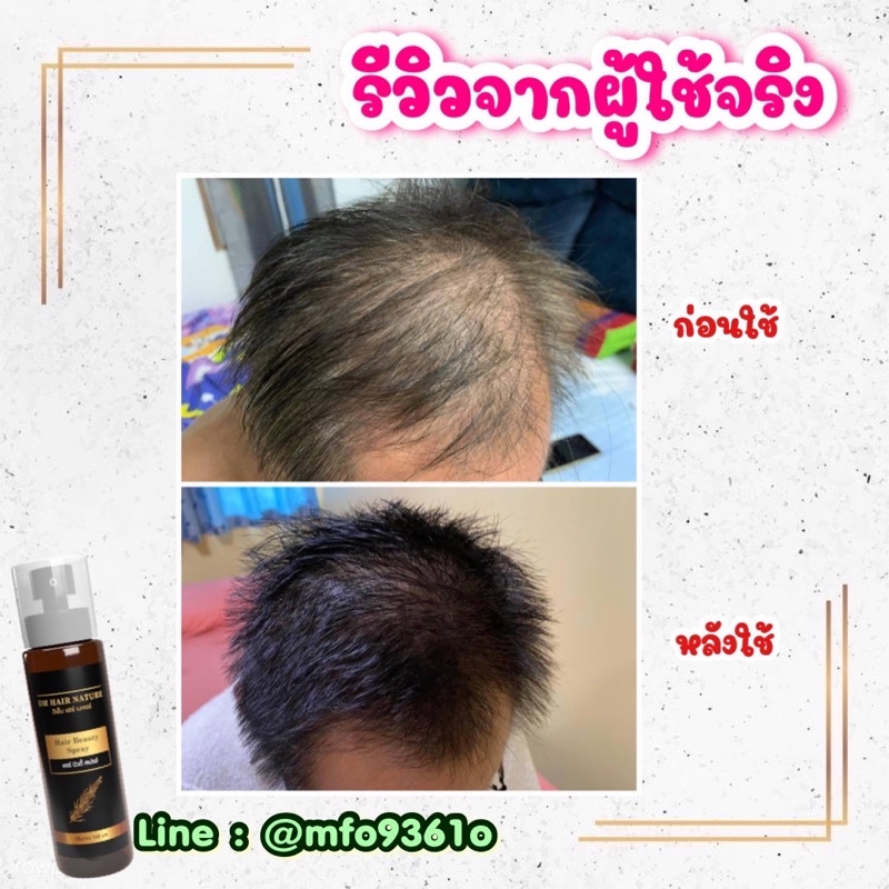 สเปรย์ปลูกผม-ลดตาแตก-หมดแล้วหมดเลย-เห็นผลตั้งแต่ขวดแรก-ลดร่วงมันคันรังแค