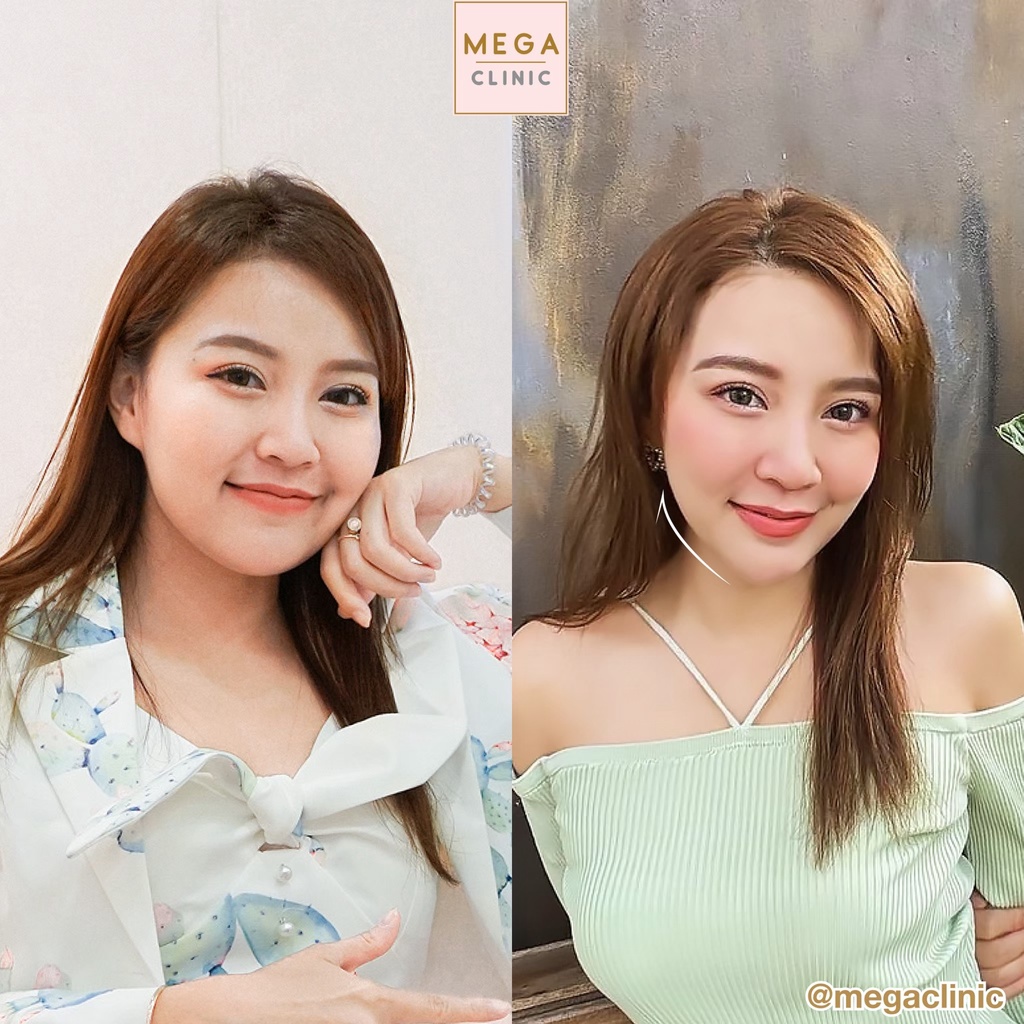 ภาพสินค้าE-voucher Lipo-S แฟตสลายไขมันเข้มข้น 8 เข็ม (20 cc) MEGA CLINIC เมกะคลินิก จากร้าน megaclinic บน Shopee ภาพที่ 1