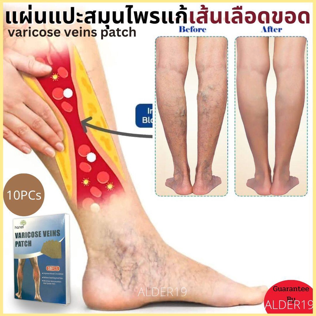 เส้นเลือดขอด-varicose-veins-patch-แผ่นแปะ-สมุนไพร-แผ่นแปะสมุนไพรแก้เส้นเลือดขอด-10-แผ่น