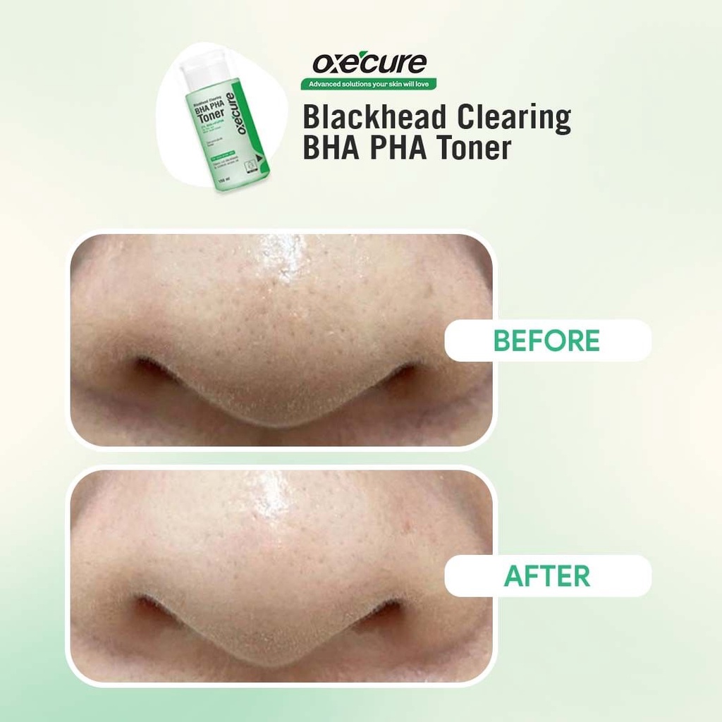 oxecure-bha-pha-toner-150ml-โทนเนอร์ลดสิว