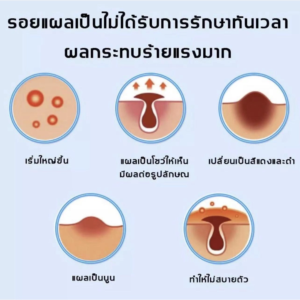 ผลลัพธ์ที่รวดเร็ว-ครีมลบแผลเป็น-20g-ครีมลดรอยแผลเป็นลดแผลไฟไหม้แผลน้ำร้อนลวกแผลผ่าตัดเป็นต้นแผลเป็นหลายประเภทยาลบลอยแผล