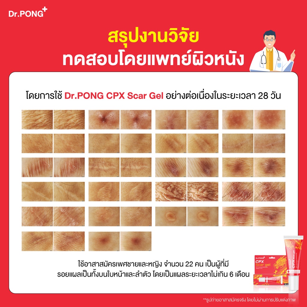 dr-pong-cpx-scar-gel-เจลซิลิโคนทางการแพทย์-ลดเลือนป้องกันรอยแผลเป็น