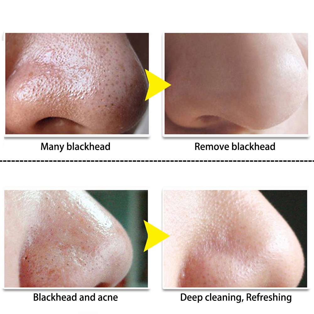 lanbena-blackhead-remover-mask-set-nose-face-pore-black-dots-cleansing-shrinking-pore-minimize-peeling-deep-cleansing-sk