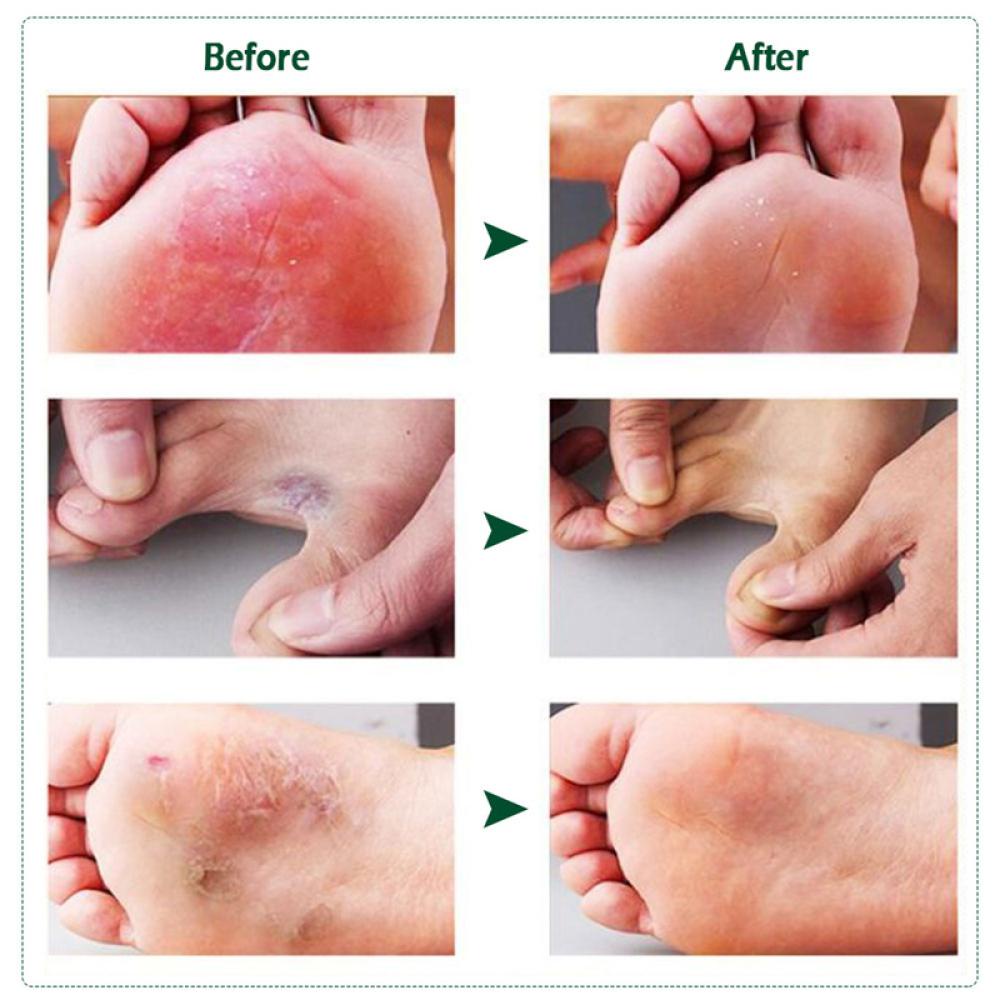 beautystarting-ครีมสมุนไพร-กําจัดเชื้อราที่เท้า-และนิ้วเท้า-ช่วยให้ความชุ่มชื้น-ป้องกันแบคทีเรีย-s9v2