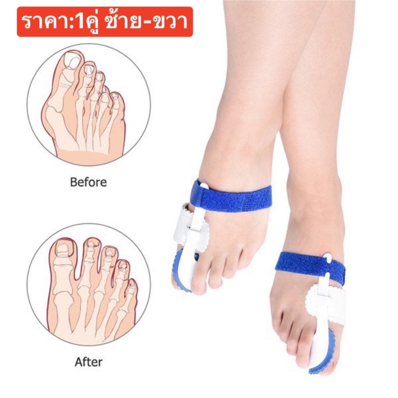 เฝือกจัดแม่เท้า1คู่-เฝือกอ่อน-ดัด-หรือจัด-แม่โป้งเท้า-ป้องกันอาการนิ้วซ้อน-เอียง-หรือเท้าเก-กระดูกผิดรูป