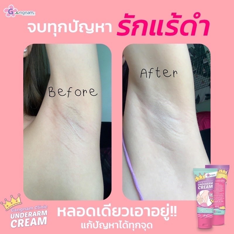 ส่งฟรี-ของแท้-กังนัม-ครีมกังนัม-gangnam-clinic-underarm-cream-ทารักแร้ขาว-ครีมรักแร้ขาว-กังนัมคลินิก-ลดกลิ่น-ลดเหงื่อ