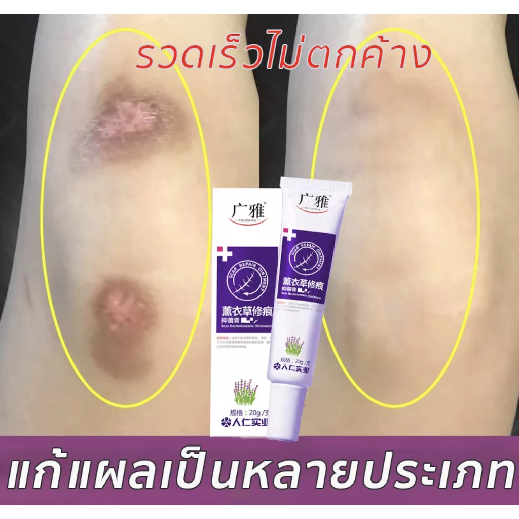 ผลลัพธ์ที่รวดเร็ว-ครีมลบแผลเป็น-20g-ครีมลดรอยแผลเป็นลดแผลไฟไหม้แผลน้ำร้อนลวกแผลผ่าตัดเป็นต้นแผลเป็นหลายประเภทยาลบลอยแผล