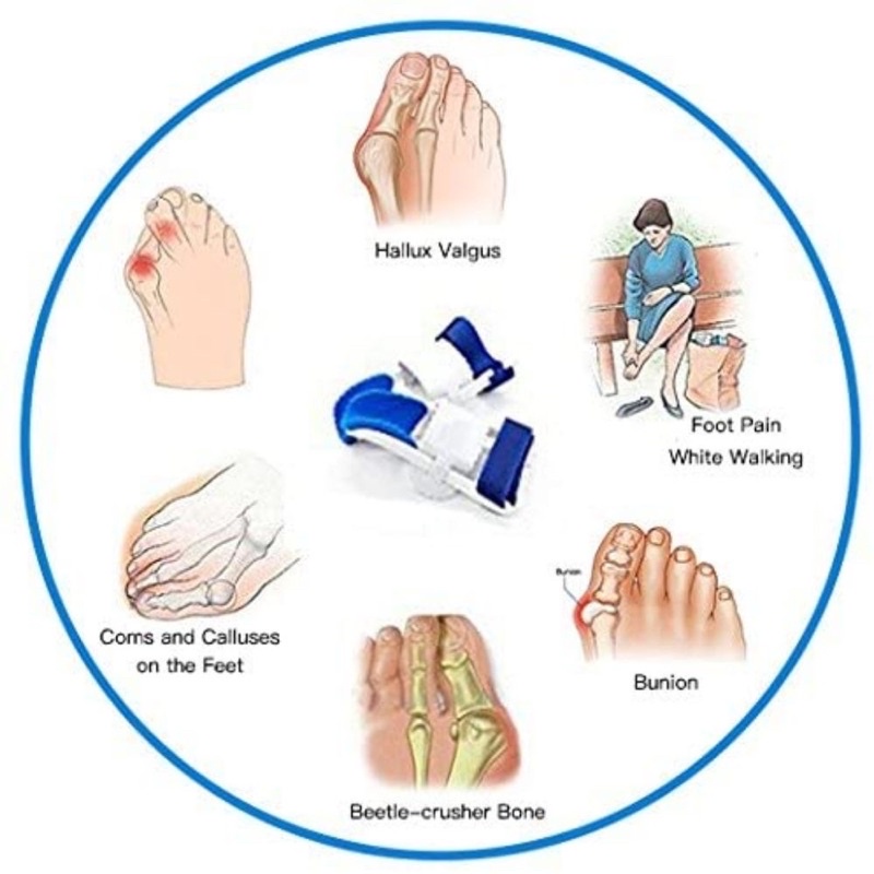 เฝือกจัดแม่เท้า1คู่-เฝือกอ่อน-ดัด-หรือจัด-แม่โป้งเท้า-ป้องกันอาการนิ้วซ้อน-เอียง-หรือเท้าเก-กระดูกผิดรูป