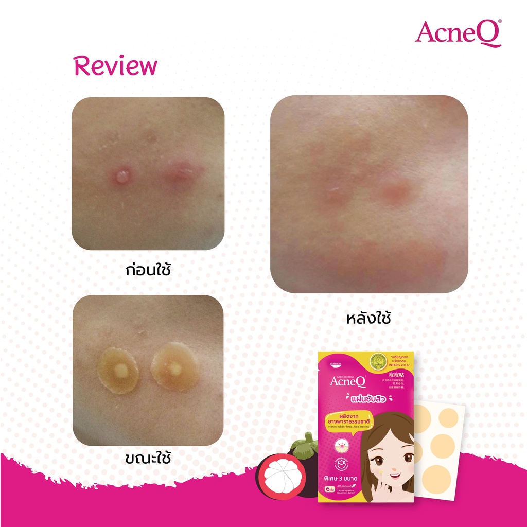 acneq-acne-dressing-acneq-แอคเน่คิว-ผลิตภัณฑ์แผ่นซับสิว