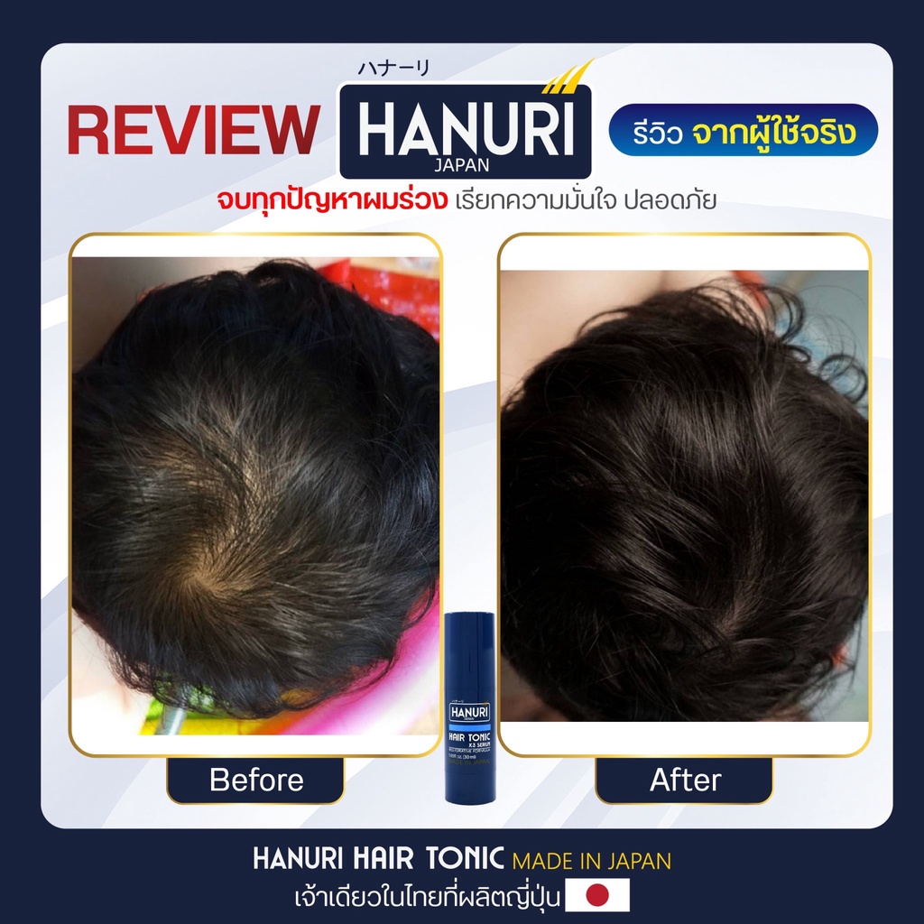 โปรพิเศษเฉพาะลูค้าใหม่-hanuri-serum-ฮานุริ-ของแท้-เซรั่มปลูกผม-ยาปลูกผม-น้ำยาปลูกผม-ลดผมร่วง-เพิ่มผม-ลดรังแค-บำรุงรากผม