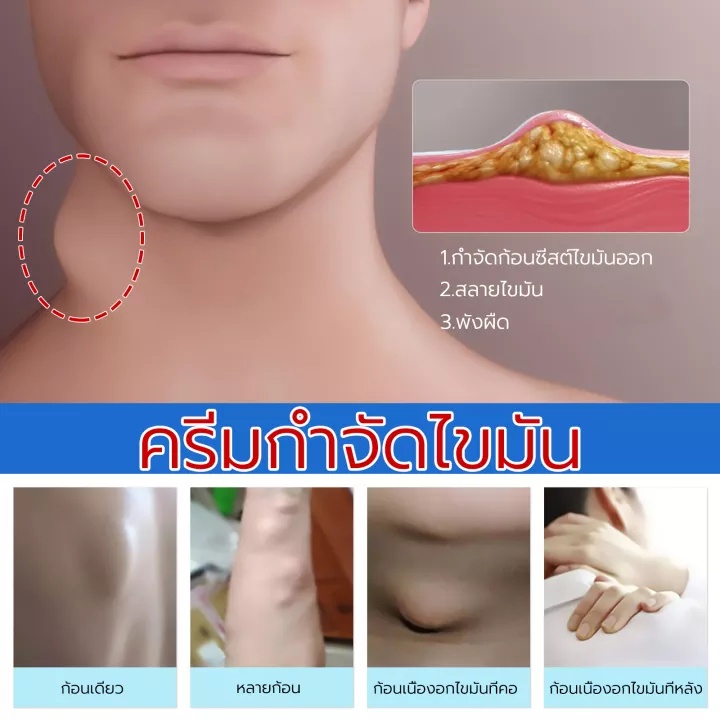 แท้-south-moon-สมุนไพรกำจัดครีมระบายน้ำเหลืองlymph-care-ointmentครีมน้ำเหลืองแบบอ่อนโยนครีมบวมคอต่อมน้ำเหลืองบริเวณรักแร