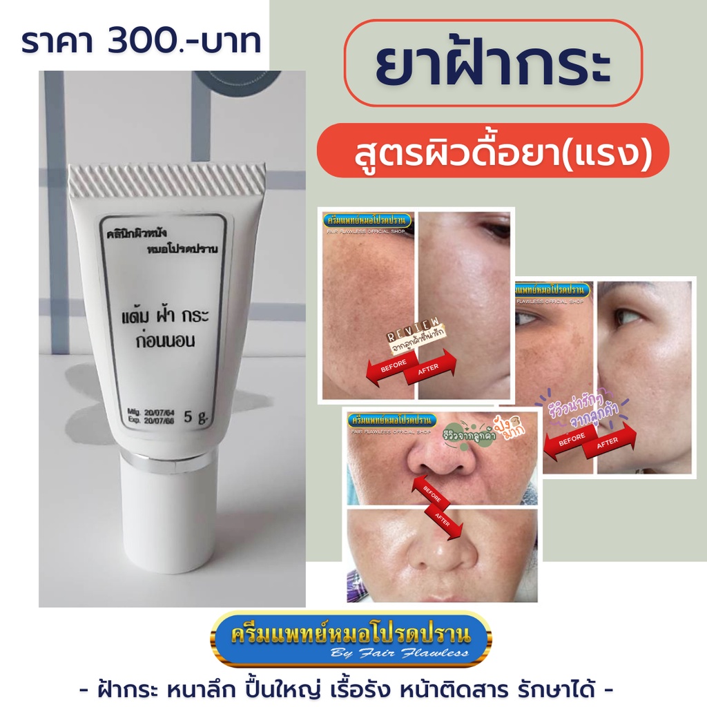 ครีมยาทาฝ้า-กระ-สูตรดื้อยา-มีของแถม-ครีมแพทย์หมอโปรดปราน