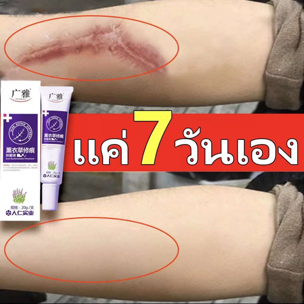 ผลลัพธ์ที่รวดเร็ว-ครีมลบแผลเป็น-20g-ครีมลดรอยแผลเป็นลดแผลไฟไหม้แผลน้ำร้อนลวกแผลผ่าตัดเป็นต้นแผลเป็นหลายประเภทยาลบลอยแผล