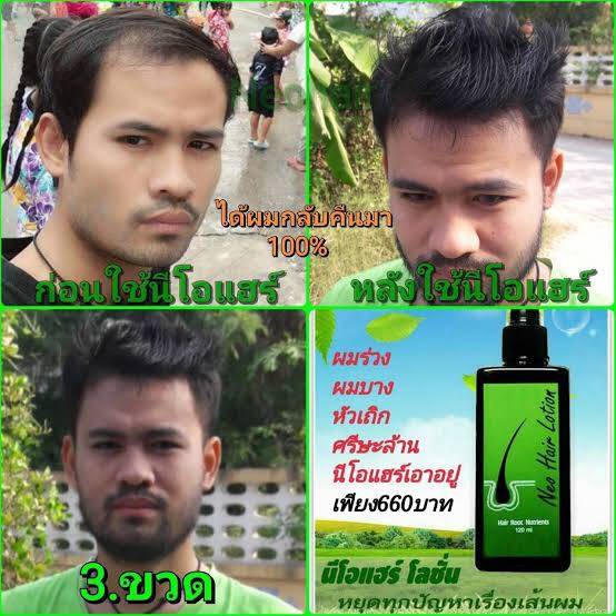 นีโอแฮร์-โลชั่น-1ขวด-ผลิตภัณฑ์บำรุงรากผม-และ-หนังศีรษะ-neo-hair-lotion